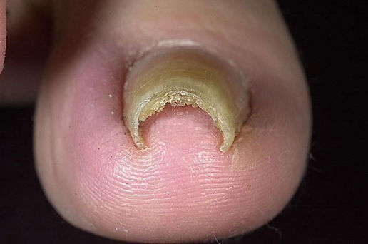 Corrective bracing for twisted nails